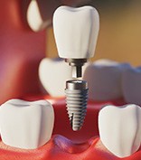 Digital image of the dental implant parts 