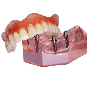 Model of an implant denture