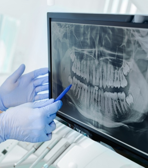 Dentist pointing to x-ray of tooth in need of tooth canal therapy