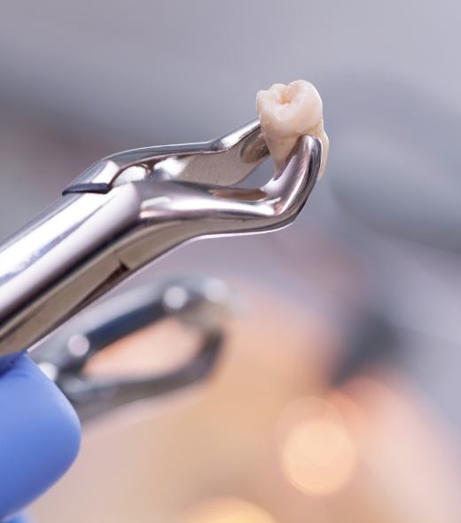 Metal clasp holding an extracted tooth