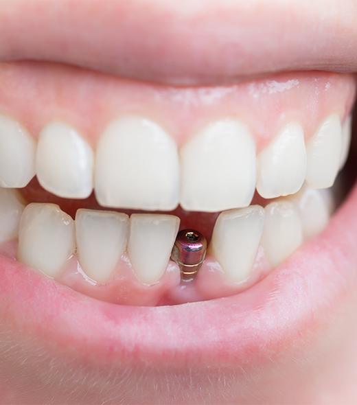 Smile with dental implant post visible where tooth was lost