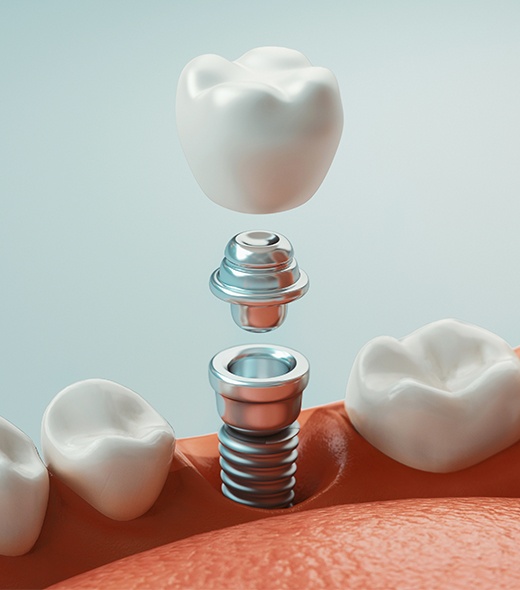 Animated dental implant supported dental crown placement