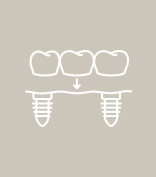 White outline of dental implant supported fixed bridge placement