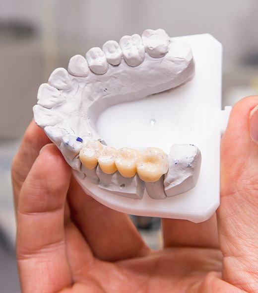 Model smile with dental bridge restoration