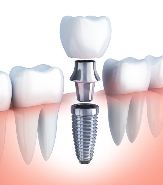 Animated dental implant supported dental crown placement