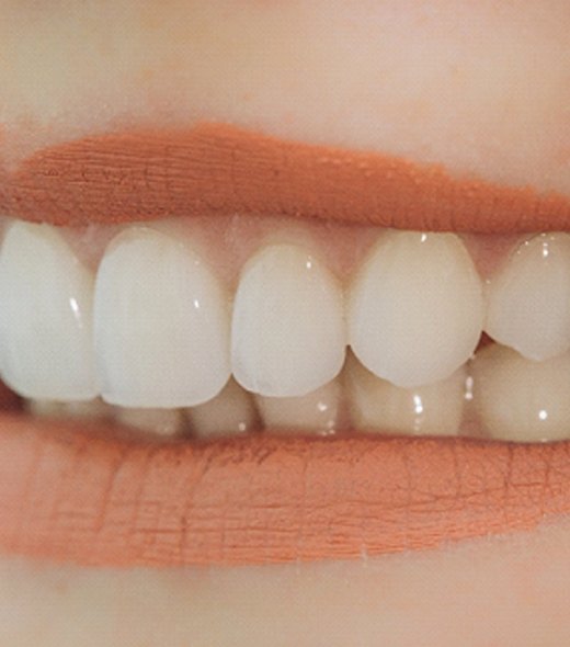 Closeup of woman smiling with dental veneers in Lubbock