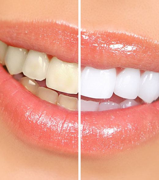 Closeup before and after comparison of teeth whitening in Lubbock 