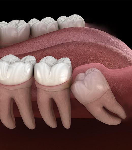 Animated smile with impacted wisdom tooth